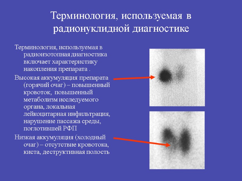 Терминология, используемая в радионуклидной диагностике Терминология, используемая в радиоизотопная диагностика включает характеристику накопления препарата